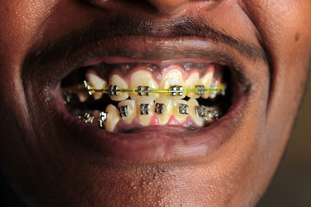 Behel atau Clear Aligner, Mana yang Cocok untuk Anda?
