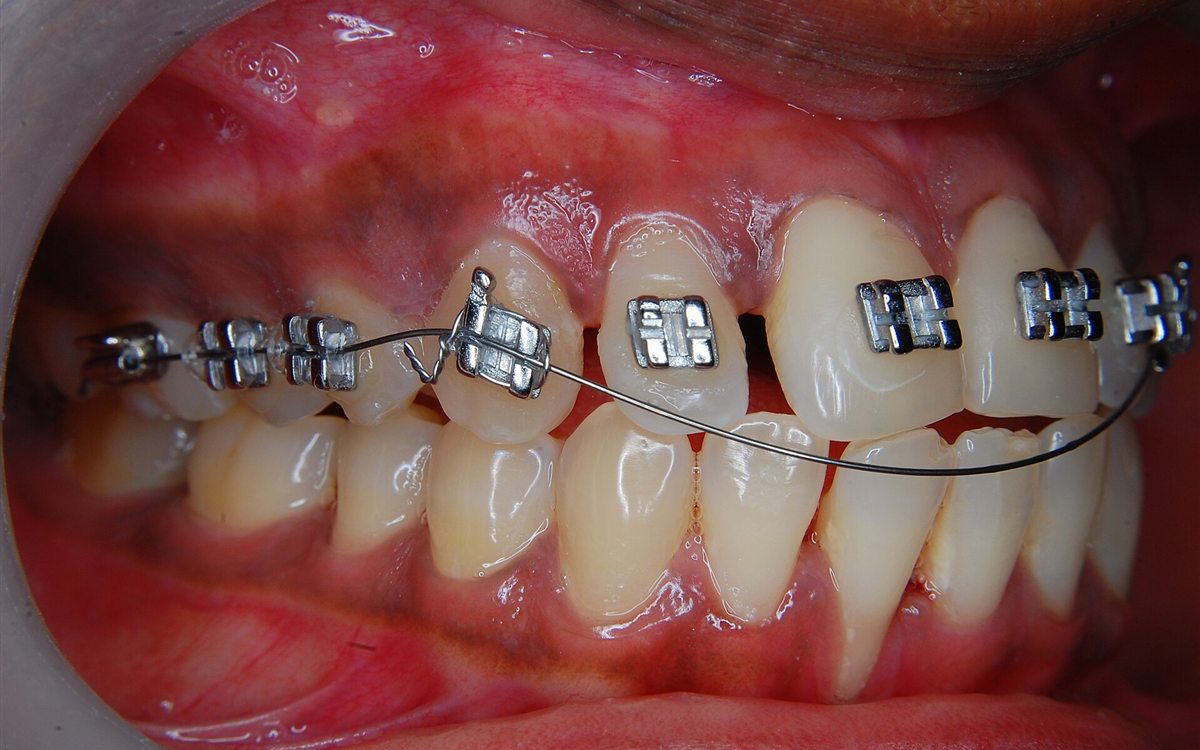 Gigi dengan behel metal (bracket) terpasang